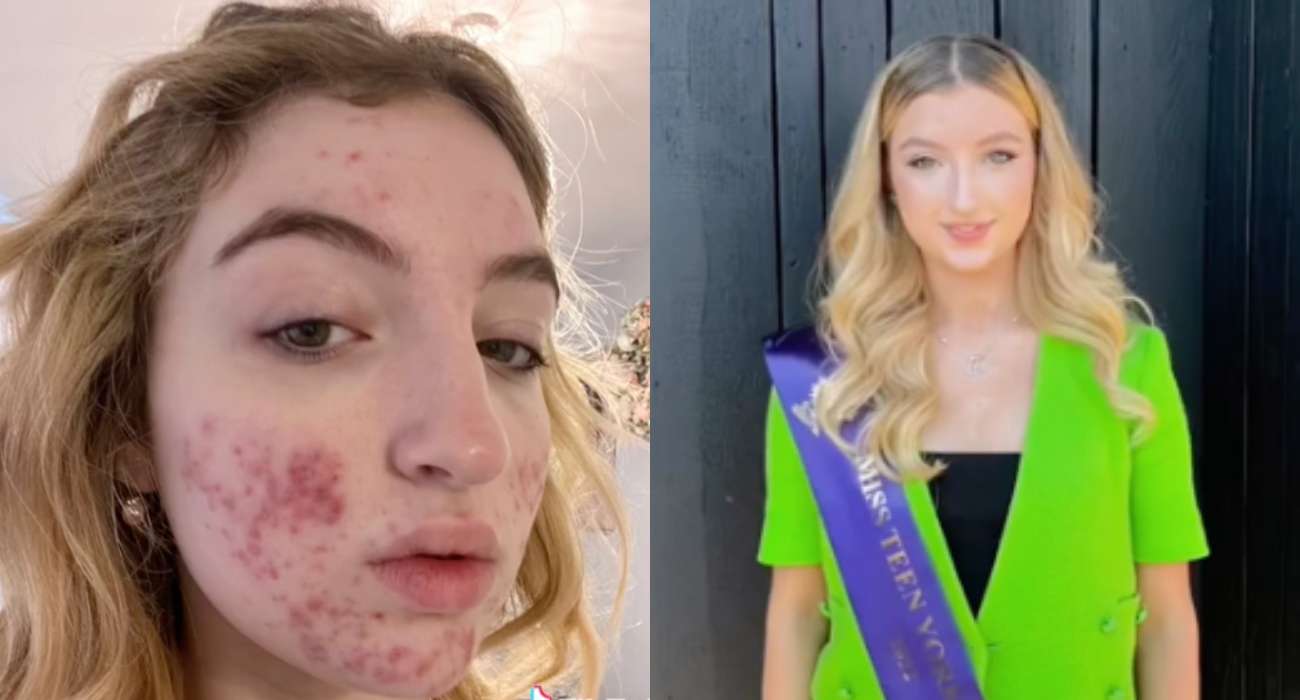 Konto nastoletniej miss zablokowane przez „drastyczne treści”. Chodziło o... trądzik