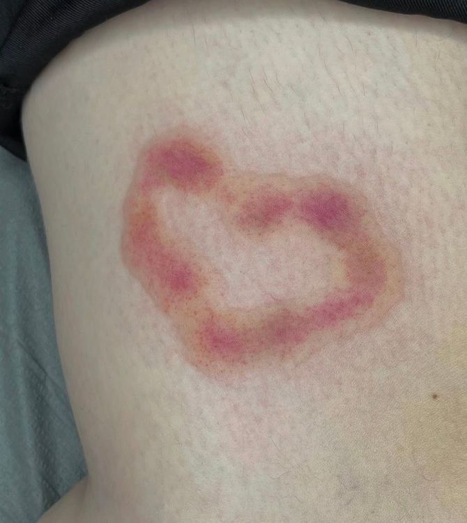 Do wesela się... nie zagoi. Skąd trend na siniaki w świecie tatuażu?