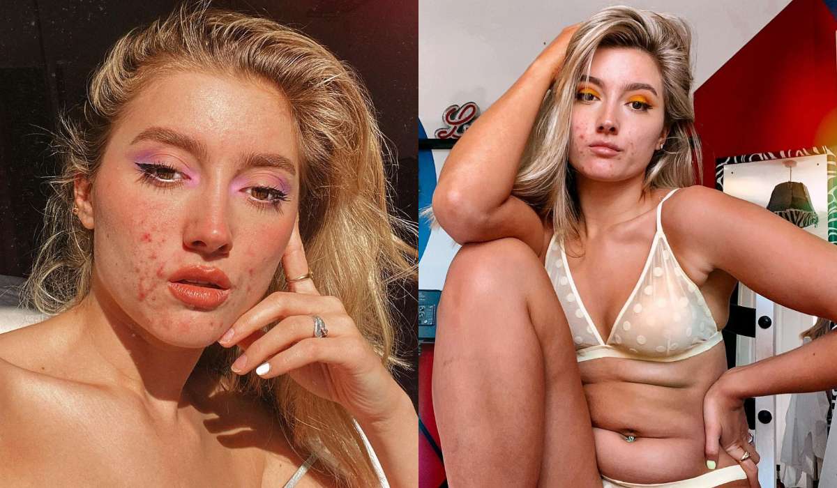 Modelka z trądzikiem reklamuje popularną markę odzieżową