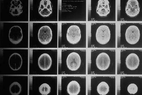 Seksizm zostawia blizny na kobiecych mózgach – dowodzą tego ogólnoświatowe badania