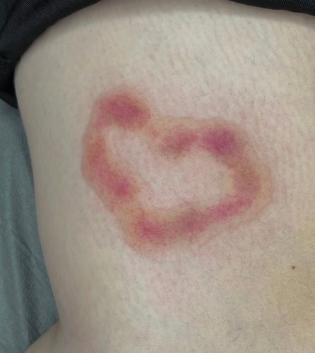 Do wesela się... nie zagoi. Skąd trend na siniaki w świecie tatuażu?